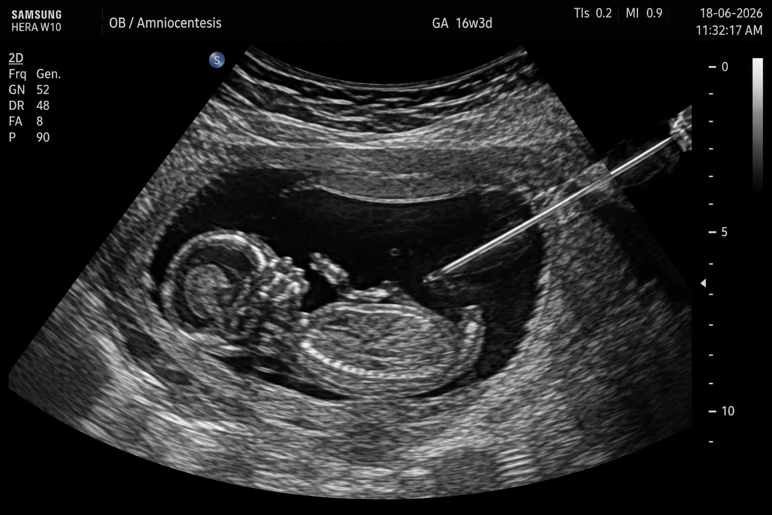 Amniocentesis