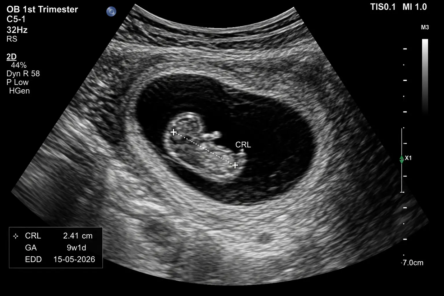 Early Pregnancy Scan
