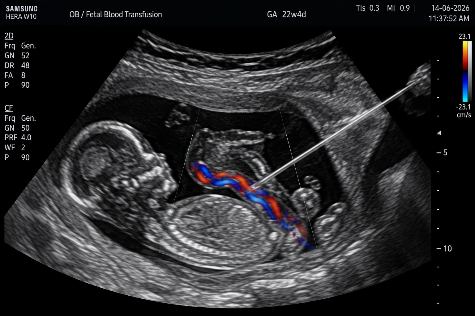 Fetal Blood Transfusion