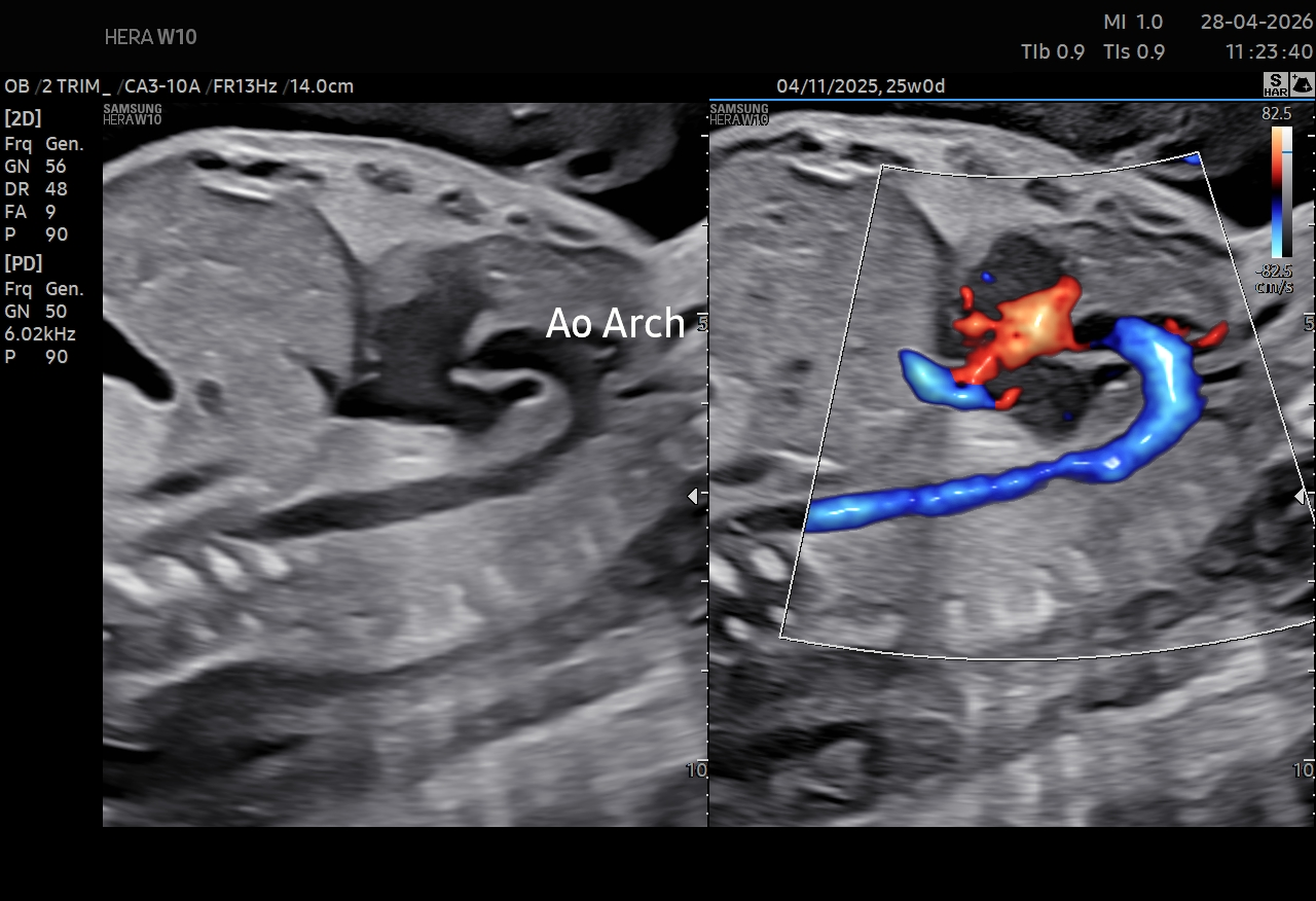 Fetal ECHO