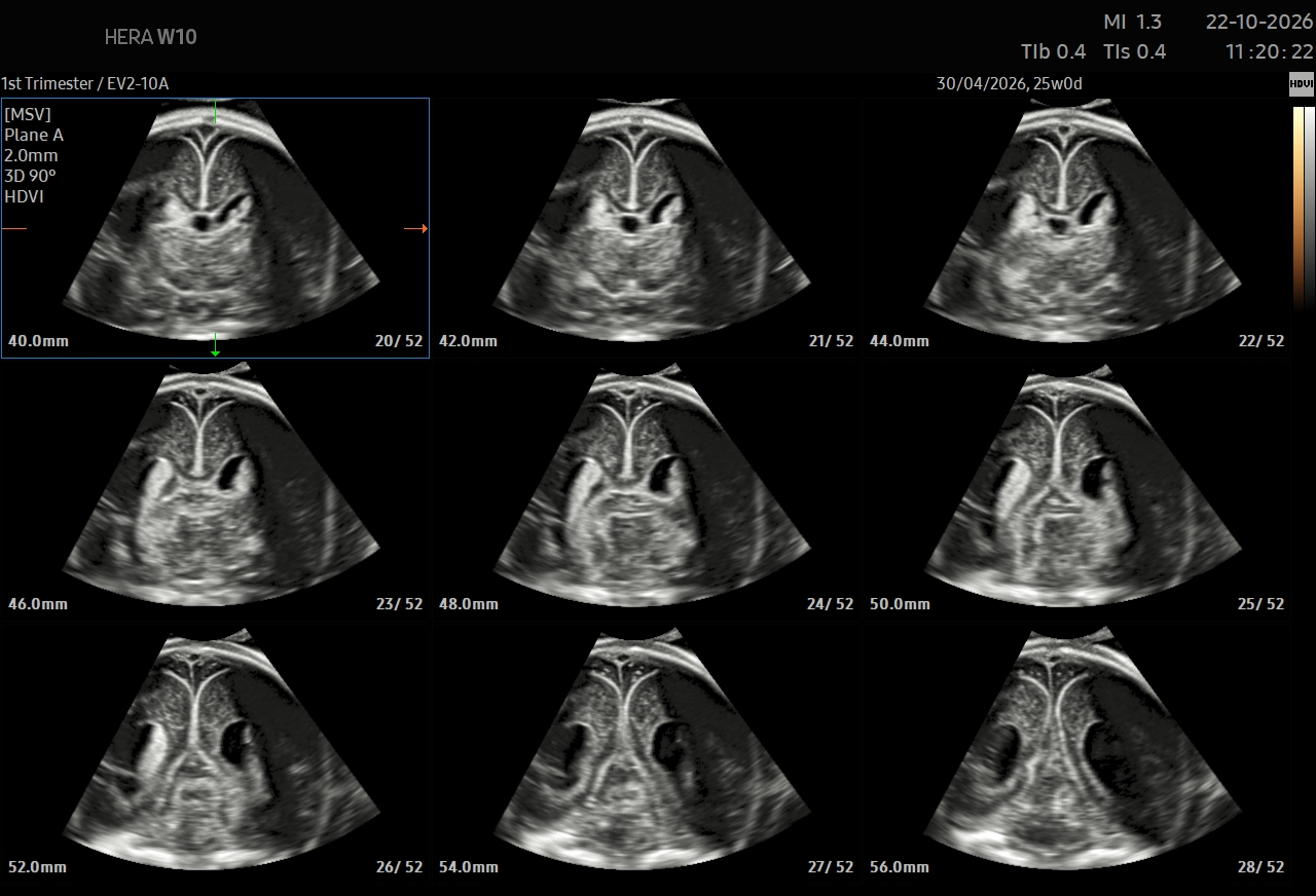 Fetal Neurosonogram