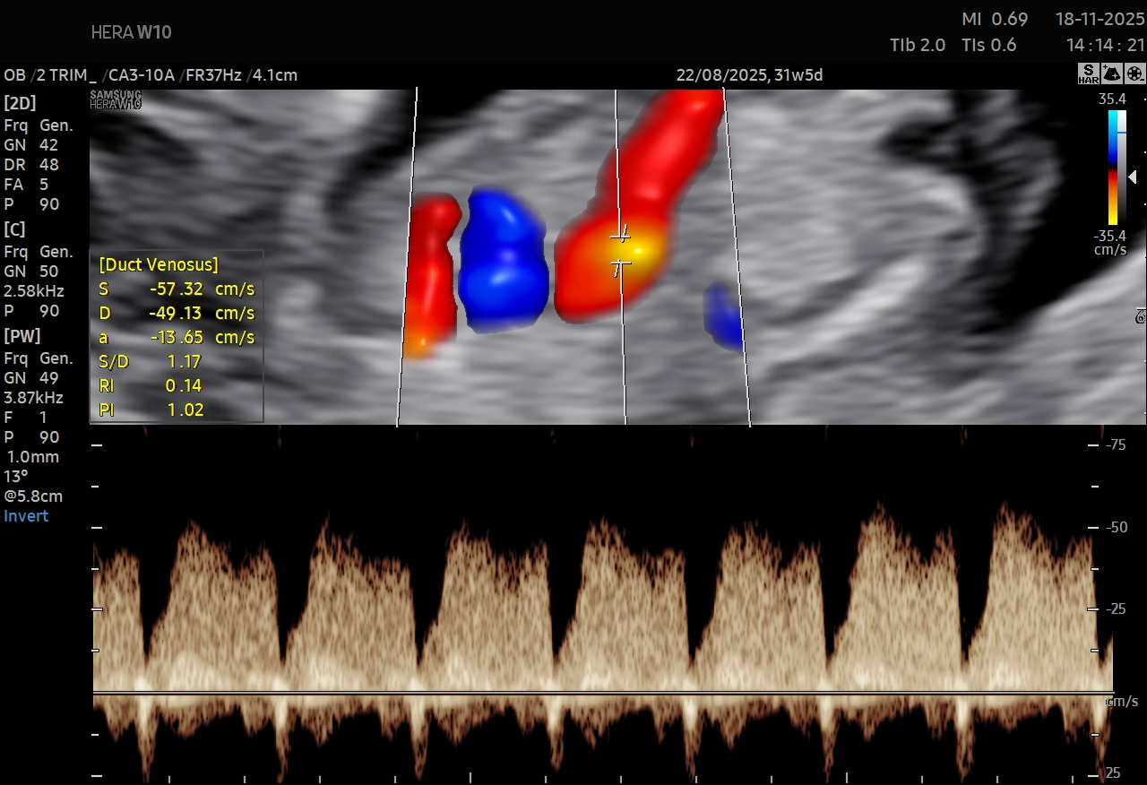 Fetal Growth and Doppler Study
