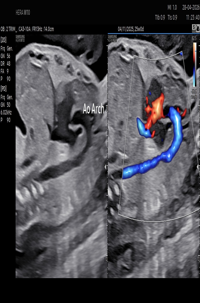 Fetal Echo Scan